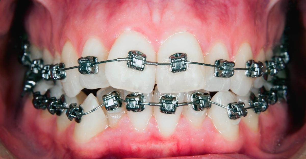 Dr Babyigit orthodontiste Strasbourg appareil dentaire avec bagues a clapet