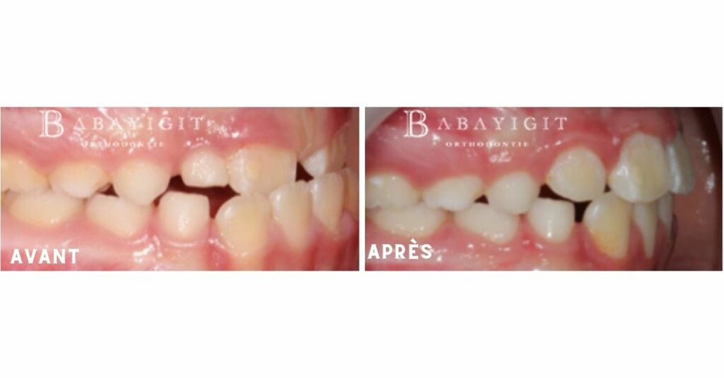 Dr babayigit avant apres orthodontie occlusion inversee