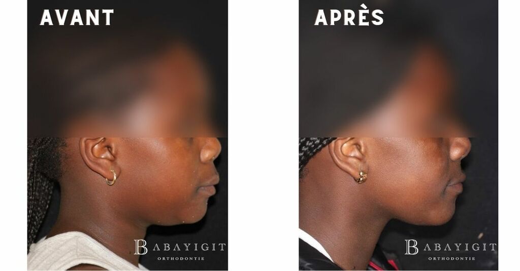 Dr babayigit avant apres orthodontie croissance mandibulaire