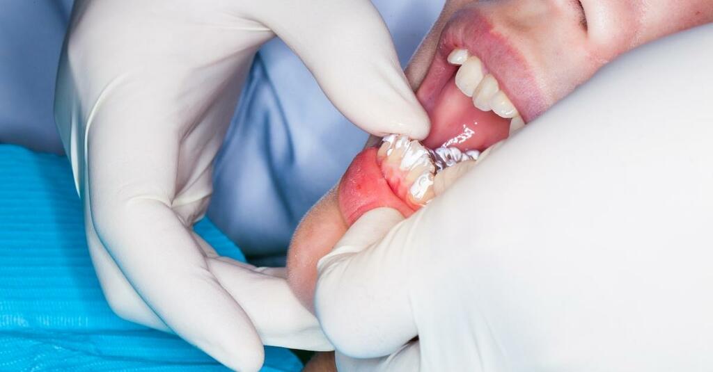 Dr Babyigit orthodontiste Strasbourg appareil invisalign teen