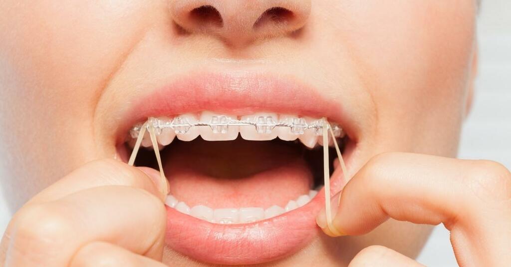 Dr Babyigit orthodontiste Strasbourg remettre ses elastique ado multi bague