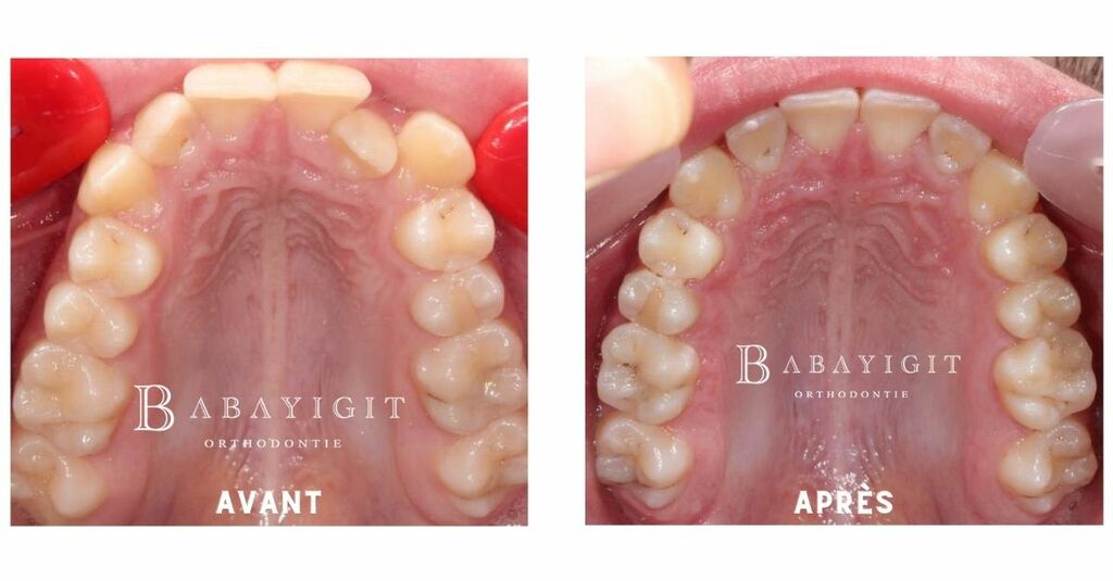Dr babayigit avant apres orthodontie expension palatine